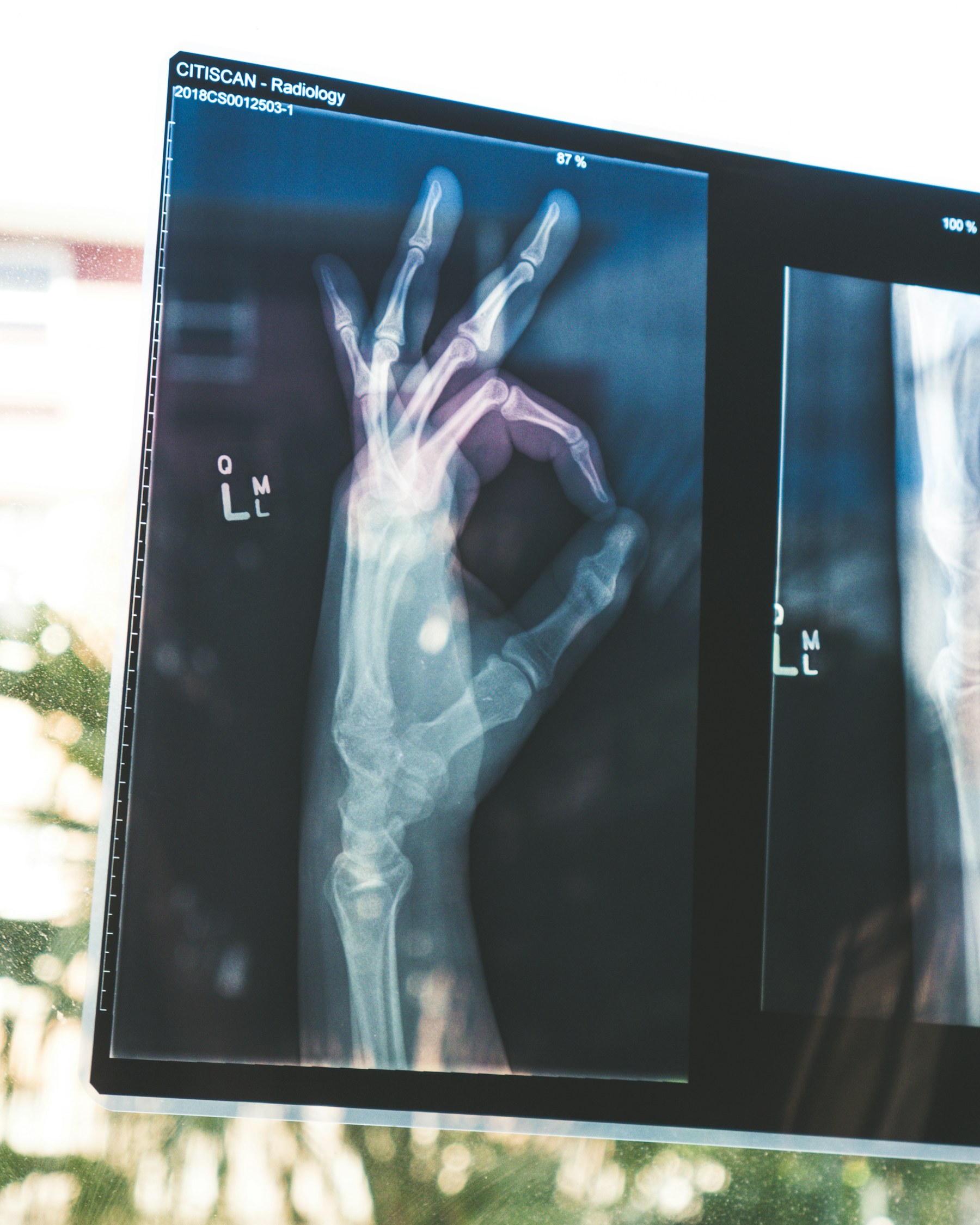 An X-ray image of a human hand